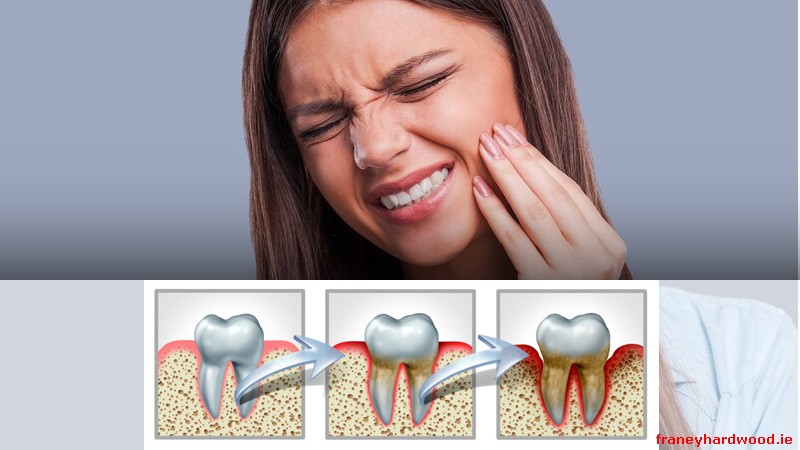 Illustration of tooth decay affecting enamel and gums.